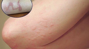 Dấu hiệu thường gặp khi nhiễm Sán Chó